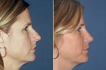 plastic surgery before and after