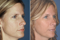 plastic surgery before and after