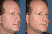 plastic surgery before and after
