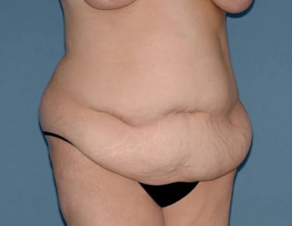 Tummy Tuck - Abdominoplasty Before & After Patient #499