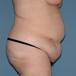 Tummy Tuck - Abdominoplasty Before & After Patient #499