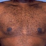 Male Breast Reduction - Gynecomastia Before & After Patient #1425
