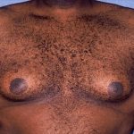 Male Breast Reduction - Gynecomastia Before & After Patient #1425