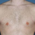 Male Breast Reduction - Gynecomastia Before & After Patient #1454
