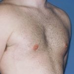 Male Breast Reduction - Gynecomastia Before & After Patient #1454