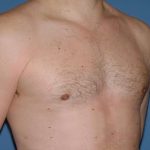 Male Breast Reduction - Gynecomastia Before & After Patient #1447