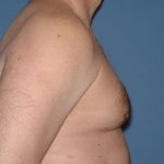 Male Breast Reduction - Gynecomastia Before & After Patient #1447