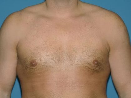 Male Breast Reduction - Gynecomastia Before & After Patient #1439