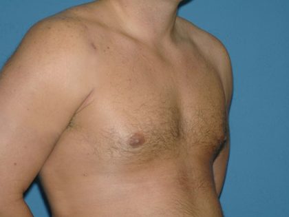 Male Breast Reduction - Gynecomastia Before & After Patient #1439