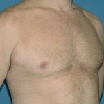 Male Breast Reduction - Gynecomastia Before & After Patient #1432