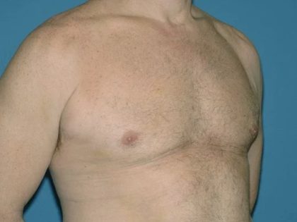 Male Breast Reduction - Gynecomastia Before & After Patient #1432