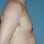 Male Breast Reduction - Gynecomastia Before & After Patient #1418