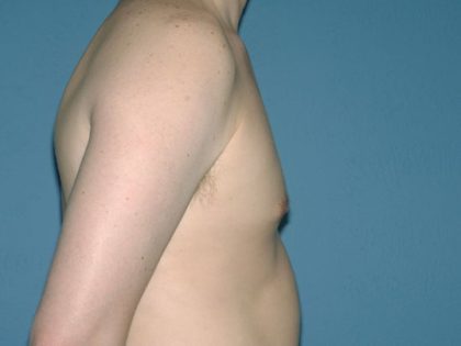 Male Breast Reduction - Gynecomastia Before & After Patient #1418