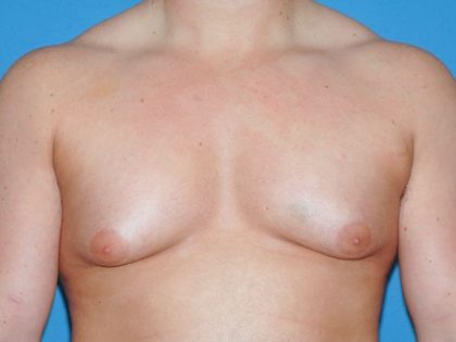 Male Breast Reduction - Gynecomastia Before & After Patient #1411
