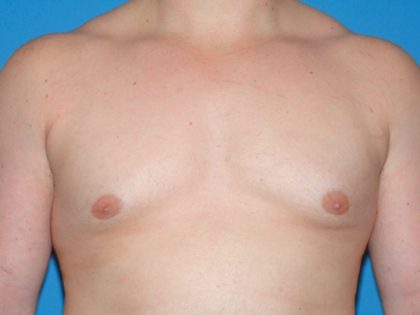 Male Breast Reduction - Gynecomastia Before & After Patient #1411