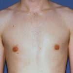 Male Breast Reduction - Gynecomastia Before & After Patient #1404
