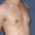 Male Breast Reduction - Gynecomastia Before & After Patient #1404