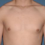 Male Breast Reduction - Gynecomastia Before & After Patient #1395