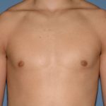 Male Breast Reduction - Gynecomastia Before & After Patient #1395