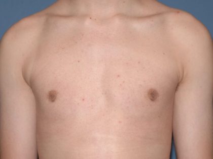 Male Breast Reduction - Gynecomastia Before & After Patient #1386