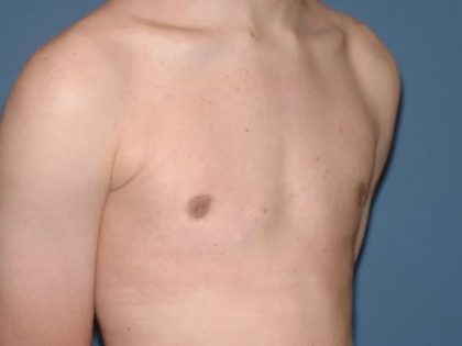Male Breast Reduction - Gynecomastia Before & After Patient #1386