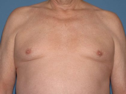Male Breast Reduction - Gynecomastia Before & After Patient #1379