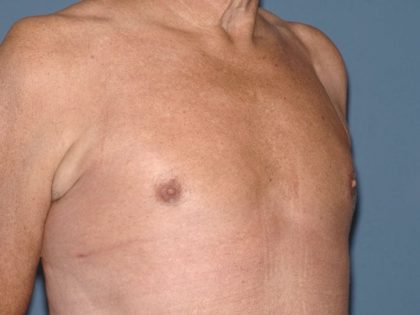 Male Breast Reduction - Gynecomastia Before & After Patient #1379