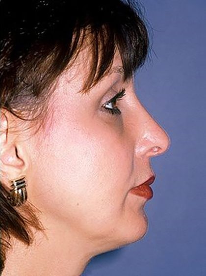 Nose Surgery - Rhinoplasty - Primary Before & After Patient #250