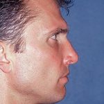 Nose Surgery - Rhinoplasty - Primary Before & After Patient #217