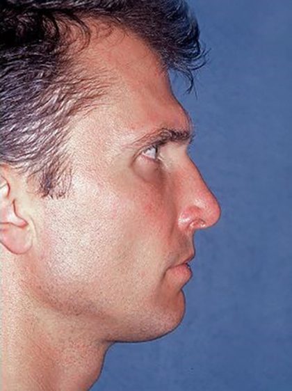 Nose Surgery - Rhinoplasty - Primary Before & After Patient #217