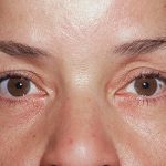 Eyelid Surgery - Blepharoplasty - Upper Eyelids Before & After Patient #358