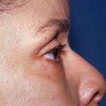 Eyelid Surgery - Blepharoplasty - Upper Eyelids Before & After Patient #358