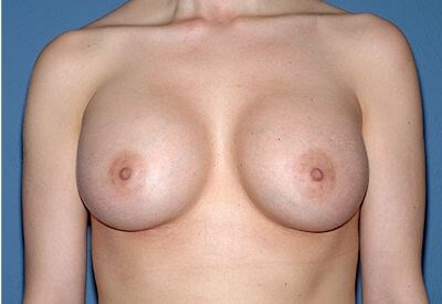 Breast Implants - Breast Augmentation Before & After Patient #1048