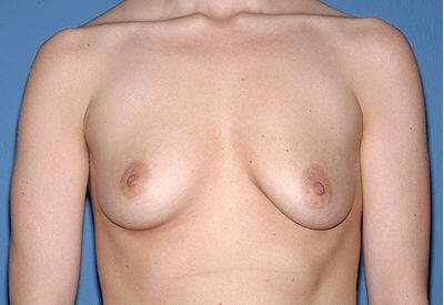 Breast Implants - Breast Augmentation Before & After Patient #1048