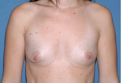 Breast Implants - Breast Augmentation Before & After Patient #1025