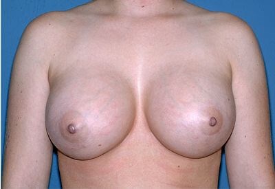Breast Implants - Breast Augmentation Before & After Patient #1011