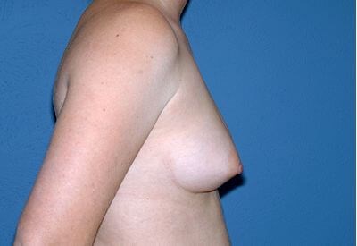 Breast Implants - Breast Augmentation Before & After Patient #1011