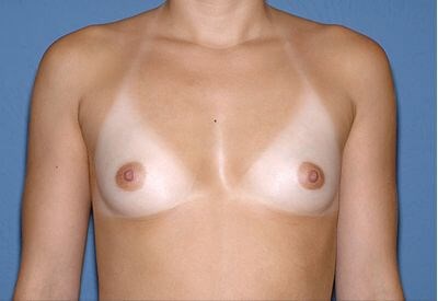 Breast Implants - Breast Augmentation Before & After Patient #997