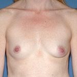 Breast Implants - Breast Augmentation Before & After Patient #986