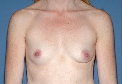 Breast Implants - Breast Augmentation Before & After Patient #986