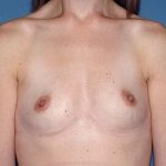 Breast Implants - Breast Augmentation Before & After Patient #977