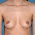 Breast Implants - Breast Augmentation Before & After Patient #967