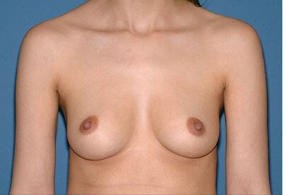 Breast Implants - Breast Augmentation Before & After Patient #967