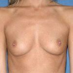 Breast Implants - Breast Augmentation Before & After Patient #950