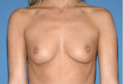 Breast Implants - Breast Augmentation Before & After Patient #950