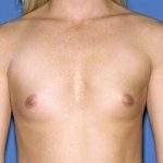 Breast Implants - Breast Augmentation Before & After Patient #889