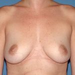 Breast Implants - Breast Augmentation Before & After Patient #1192