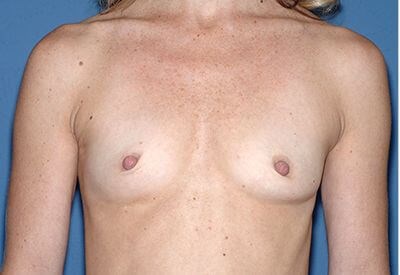 Breast Implants - Breast Augmentation Before & After Patient #1181