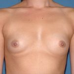 Breast Implants - Breast Augmentation Before & After Patient #1154