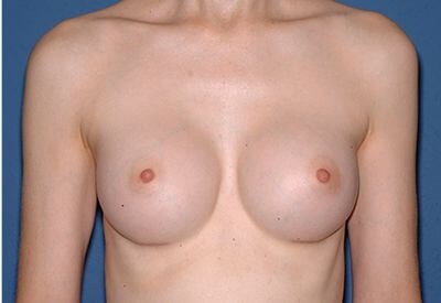 Breast Implants - Breast Augmentation Before & After Patient #1134